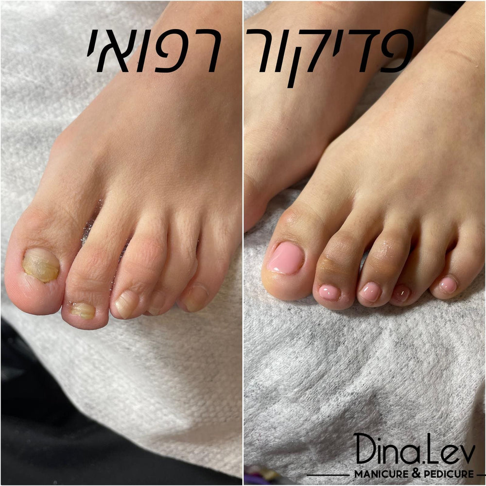 ציפורניים בעייתיות