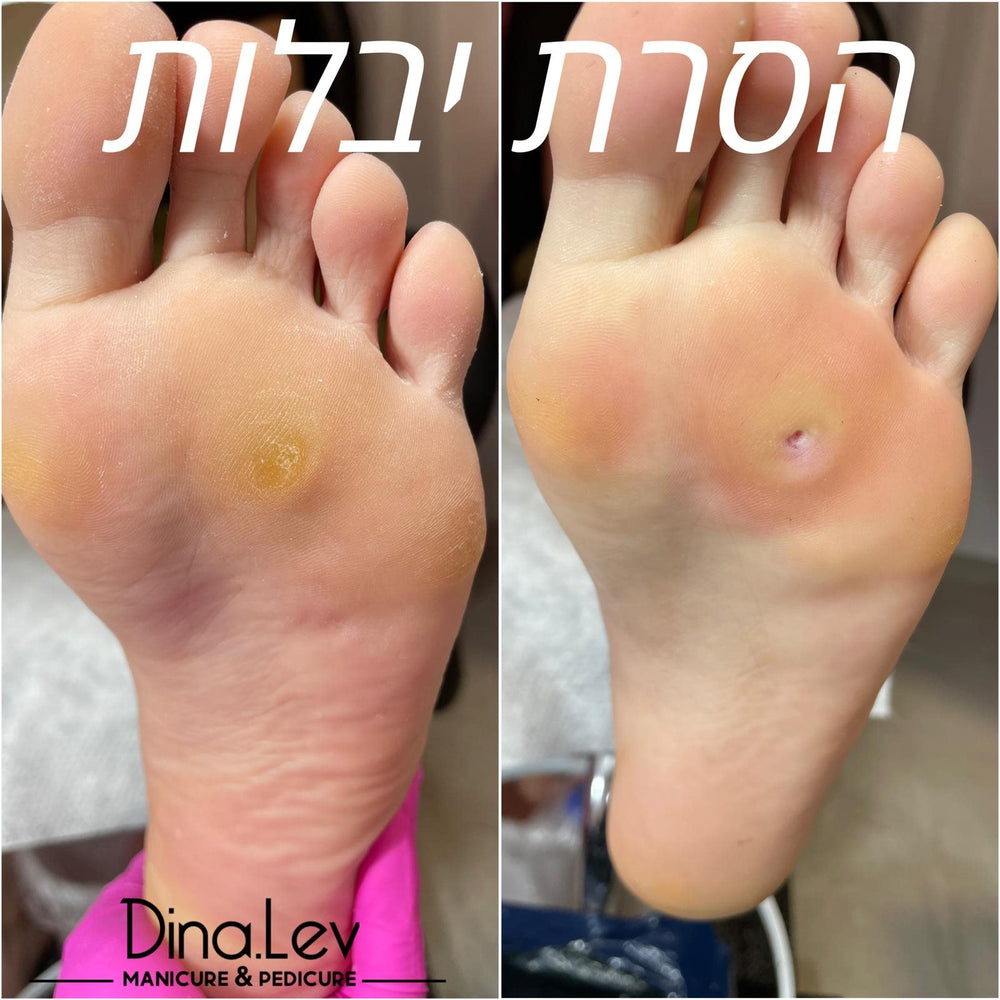 הסרת יבלות