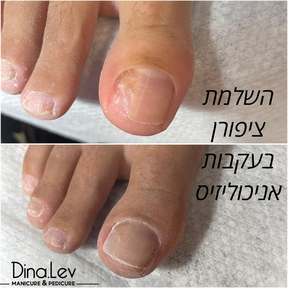 השלמת ציפורן